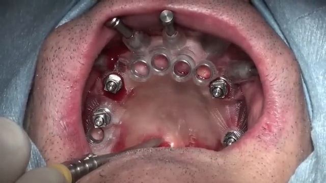 Carico immediato protesi definitiva in titanio ,chirurgia guidata Nobelguide,Nobel Biocare смотреть онлайн
