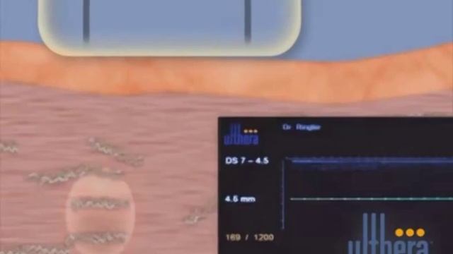 ПОДТЯЖКА ВЕРХНЕЙ ГУБЫ смотреть онлайн