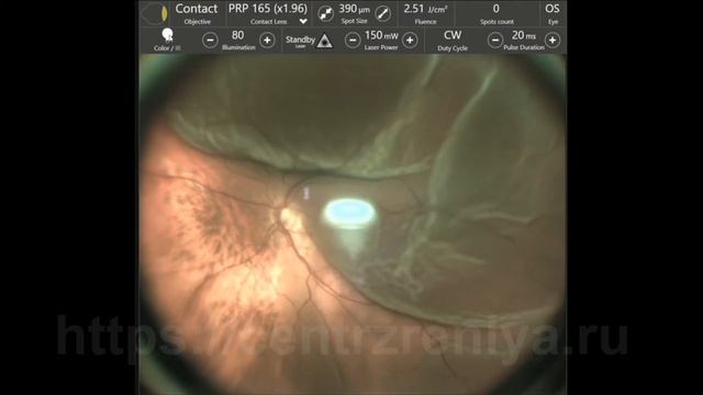 Отслойка сетчатки видео в реальном времени смотреть онлайн
