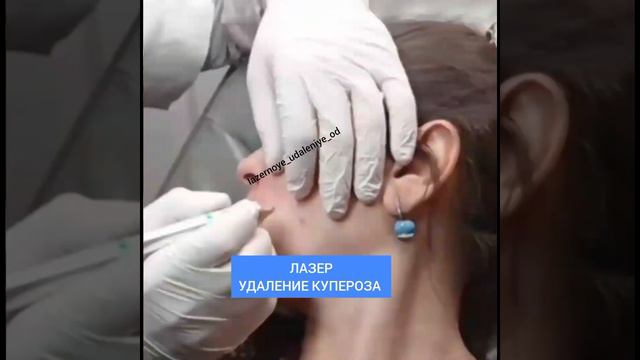 Лазерное удаление купероза на лице смотреть онлайн