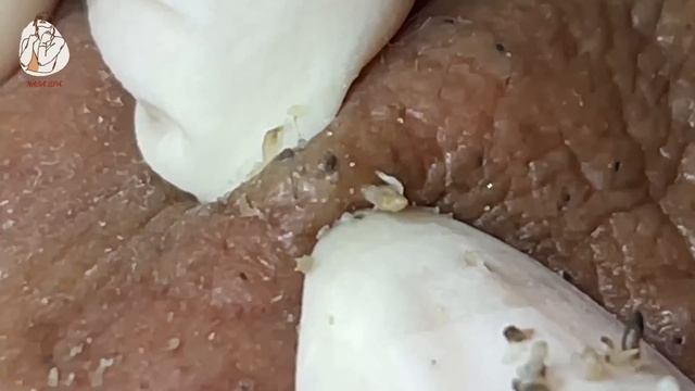 Treatment Of Blackheads And Hidden Acne #032 смотреть онлайн