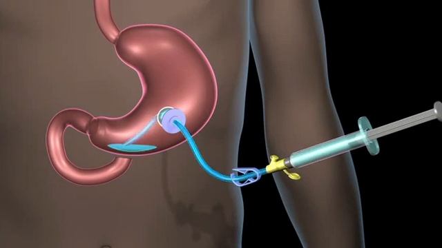 Introduction to Home Tube Feeding смотреть онлайн
