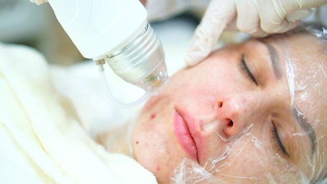 Микроигольчатый RF-лифтинг смотреть онлайн