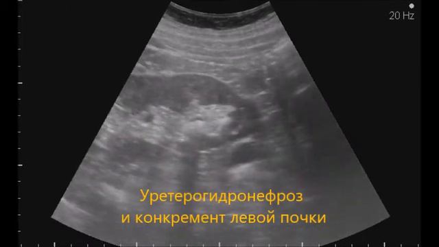 Уретероцеле и его осложнения смотреть онлайн
