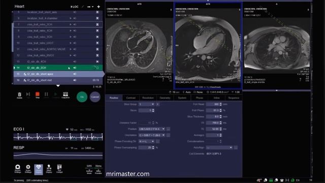 Планинг МРТ СЕРДЦА на новом интерфейсе аппарата МРТ Сименс. смотреть онлайн