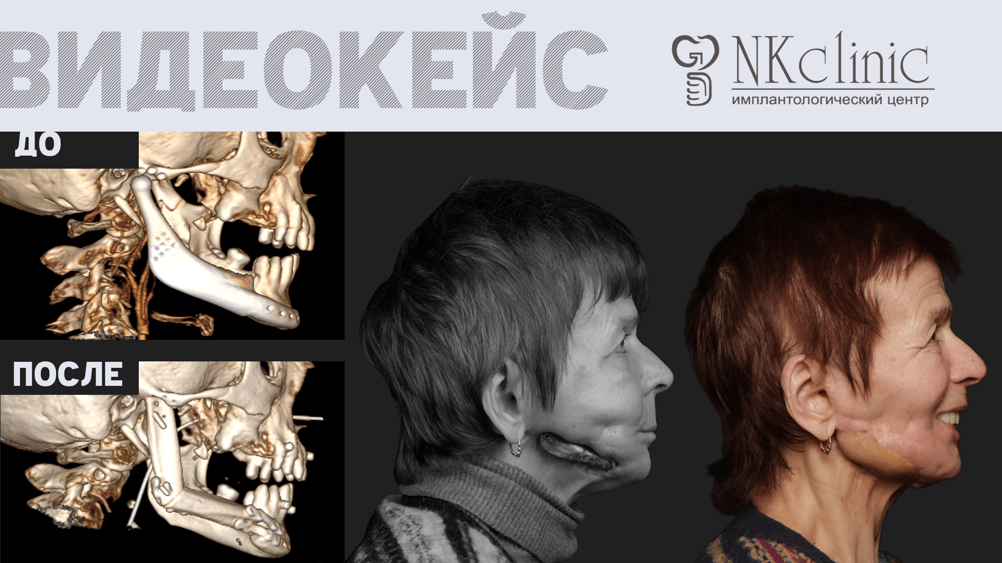 Титановый протез прорезал челюсть. Лечение пациентки врачами NKclinic