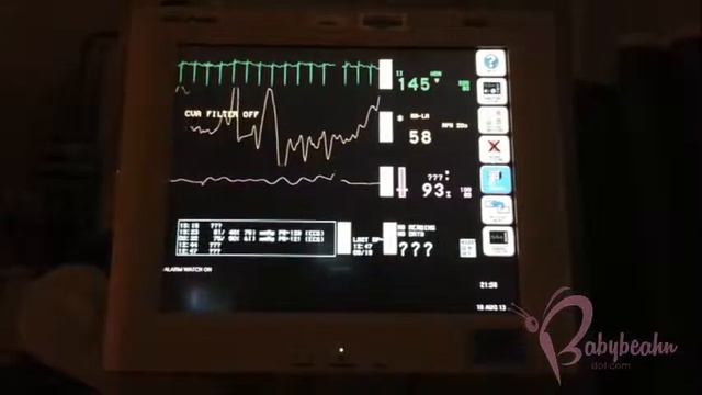 ["Inspire", in HD] - Congenital Heart Defect Survivor with Down Syndrome/Trisomy 21 смотреть онлайн