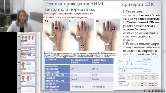 Оптимизация клинико-нейрофизиологич-го алгоритма обследования пац-ов с синдромом запястного канала смотреть онлайн