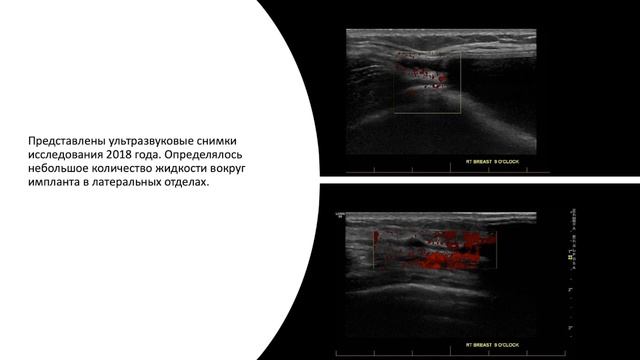 ИМПЛАНТЫ МЖ И  ЛИМФОМА