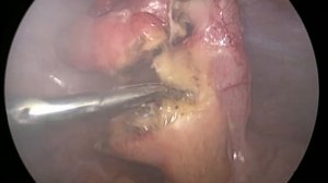 Лапароскопическая аппендэктомия при остром флегмонозном аппендиците