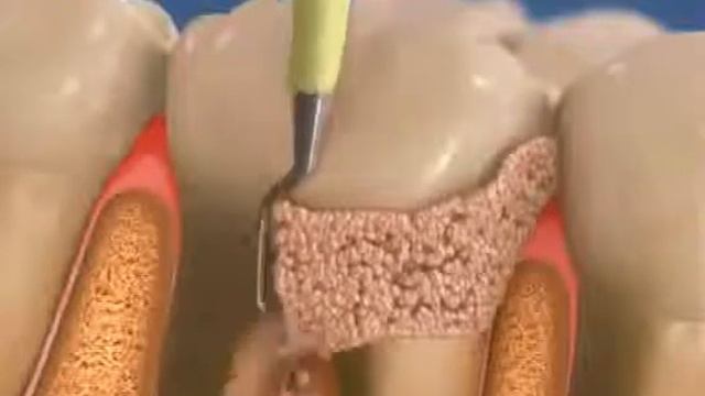 Ультразвуковая чистка зубов смотреть онлайн