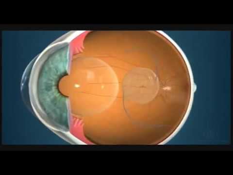 Линзы. Мультифокальные линзы смотреть онлайн