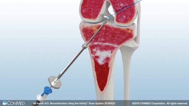 All-Inside ACL Reconstruction Using The Infinity™ Knee System - CONMED Animation