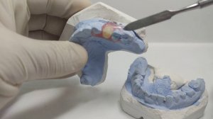 протез бабочка