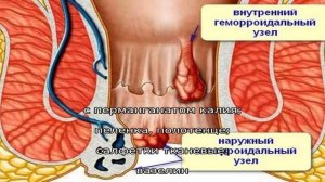 Ванночки и клизмы с марганцовкой при геморрое