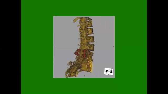 3 D IMAGE DISPLAY, 3D RECONSTRUCTION, SURFACE &VOLUME RECONSTRUCTION, VIRTUAL COLONY SCOPY, MIP, Mi смотреть онлайн