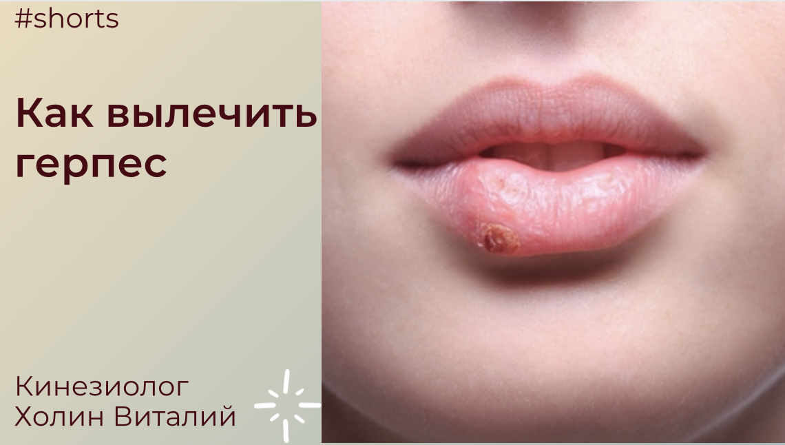 Как вылечить герпес смотреть онлайн