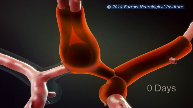 Vasospasm смотреть онлайн