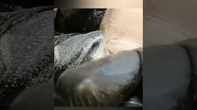 Зачистка онихолизиса фрезами, работа с грибком ногтей. смотреть онлайн