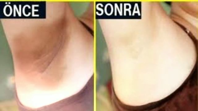 Koltuk Altı Kararması Nasıl Geçer / Evde Doğal Çözümler смотреть онлайн