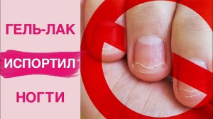 Чем опасен гель лак? Аллергия, ожог, онихолизис