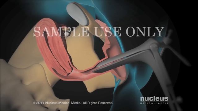 Dilation and Curettage (D & C) смотреть онлайн