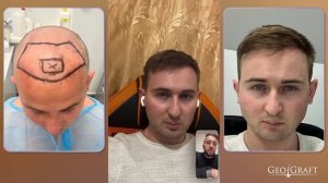 Пересадка волос в Москве, отзыв пациента GeoGraft.  Цена фиксированная 120 тыс.₽