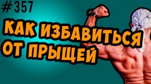 Акне. Прыщи. Как избавиться от прыщей.