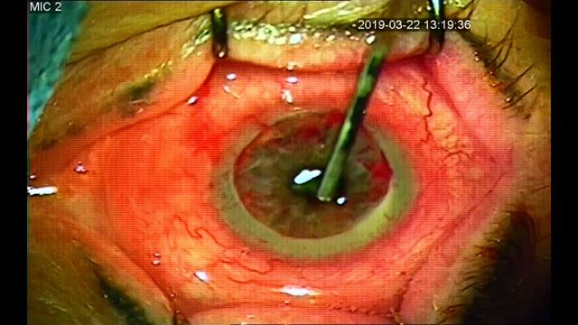 Сквозная кератопластика