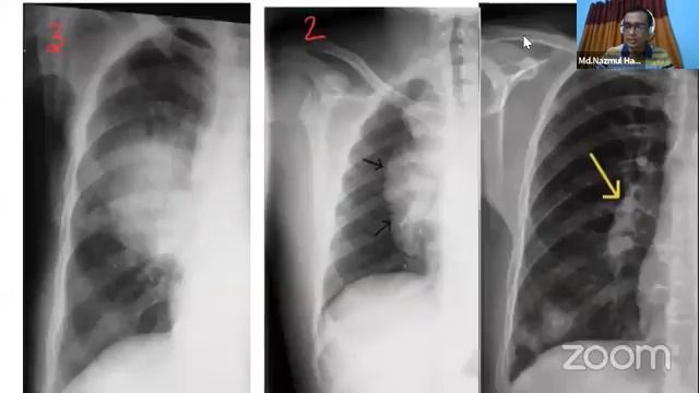 Hilar Abnormalities смотреть онлайн