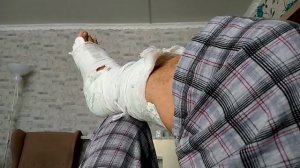 Перелом пяточной кости - начало.