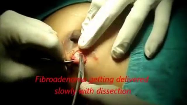 Fibroadenoma Removal Surgery