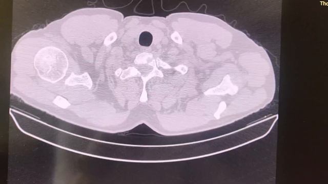 Силикоз (Silicosis)