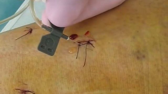 PRP терапія рубців смотреть онлайн