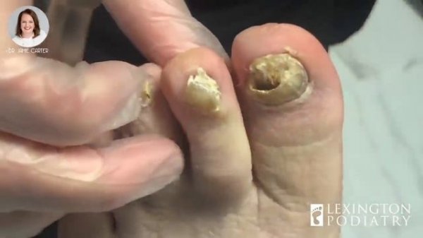 FUNGAL NAIL TRIM
