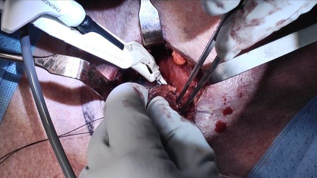 Total Thyroidectomy With Central Neck Dissection