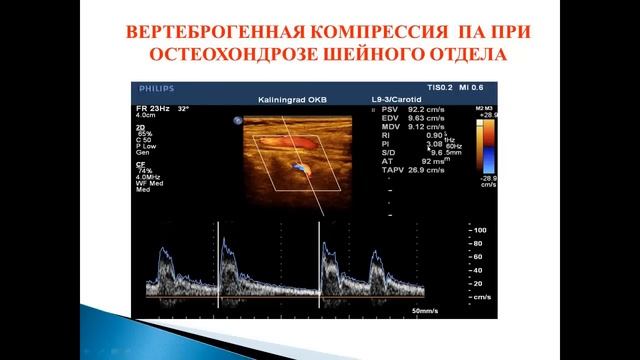 Ультразвуковая диагностика патологии вертебро-базилярной системы смотреть онлайн
