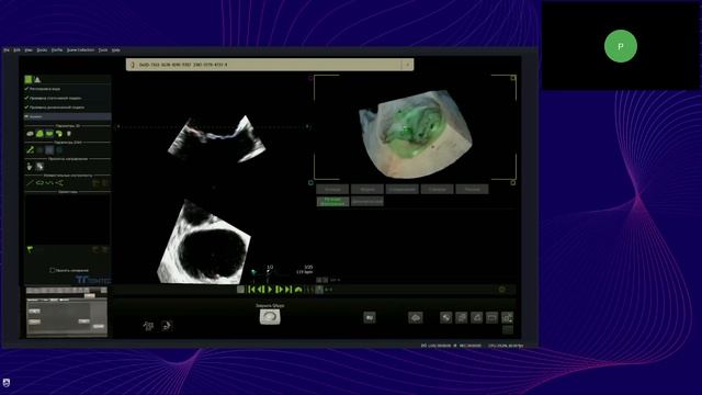 Инструменты количественной оценки при проведении 3D эхокардиографии на УЗ-аппаратах Philips смотреть онлайн