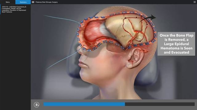 Traumatic Brain Injury - Brain Surgery Animation смотреть онлайн