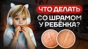 Что делать со ШРАМОМ У РЕБЕНКА? | Как сделать его НЕ ЗАМЕТНЫМ?