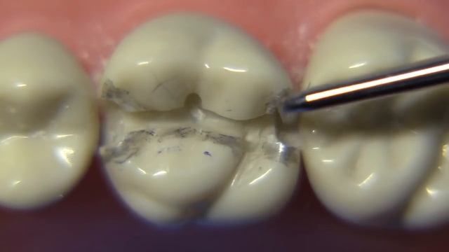Class II Amalgam Preparation #14 MOD | Amalgam Preparation Technique смотреть онлайн