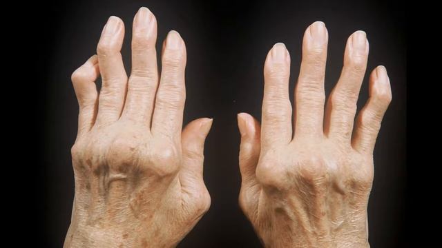 ЧТО ТАКОЕ АРТРИТ И АРТРОЗ, ЕГО СИМПТОМЫ И КАК ЛЕЧИТЬ