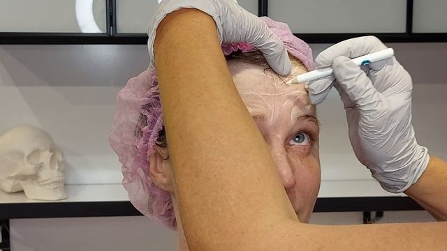 Токсин разметка. Клиент-подруга. Визит 2 р.в год.