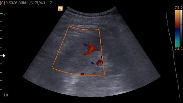 Рак правой почки смотреть онлайн