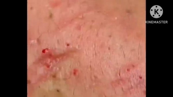 Big Cystic Acne Blackheads Extraction Blackheads & Milia Whiteheads Remova...