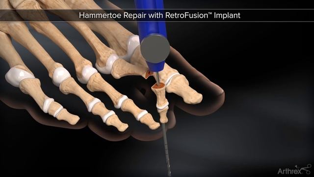 Hammertoe Repair with RetroFusion™ Implant смотреть онлайн