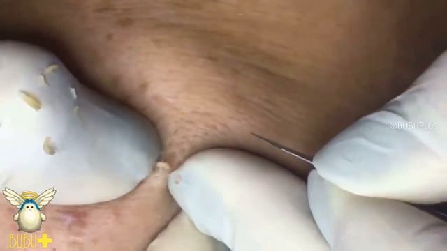 Черные #угри и белые угри на лице