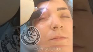 Удаление ниодимовым лазером перманентного татуажа бровей