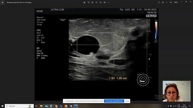 Ectasia ductal na mama смотреть онлайн