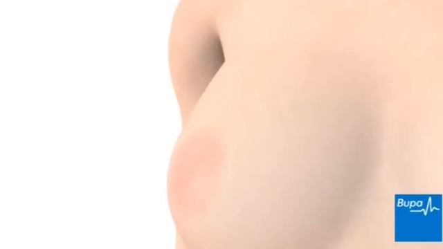 How a core breast biopsy is taken смотреть онлайн